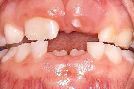 Billedet viser fembrud af de første blivende tænder. 