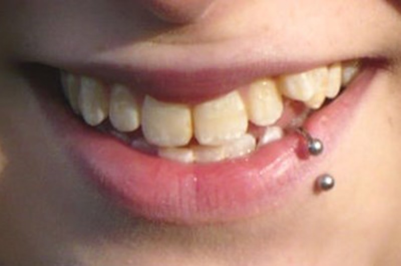 Billedet viser et stort smil med en læbepiercing.