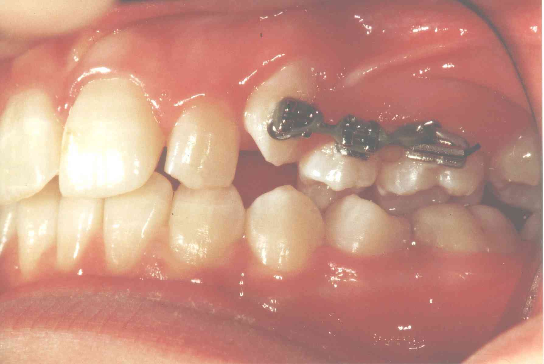 Billedet viser et tandsæt med en fast sektionsbøjle over nogle få tænder. 