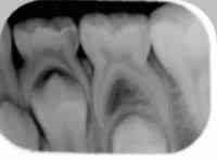 Røntgenbillede af tandfrembrud.