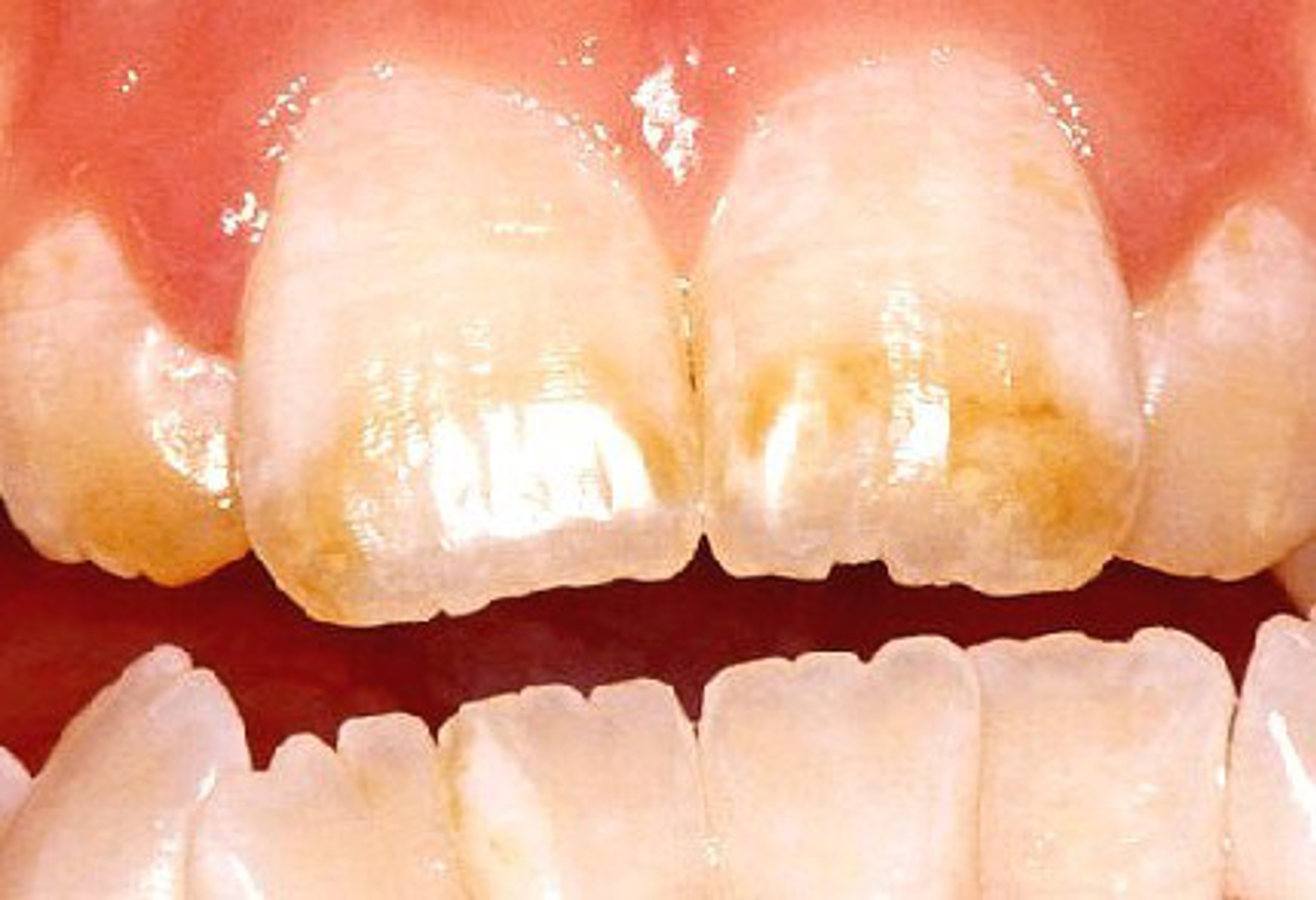 Billedet viser kraftig misfarvning af fortænderne.