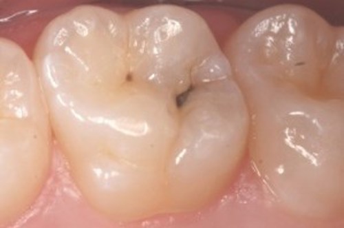 Billedet viser en kindtand med caries