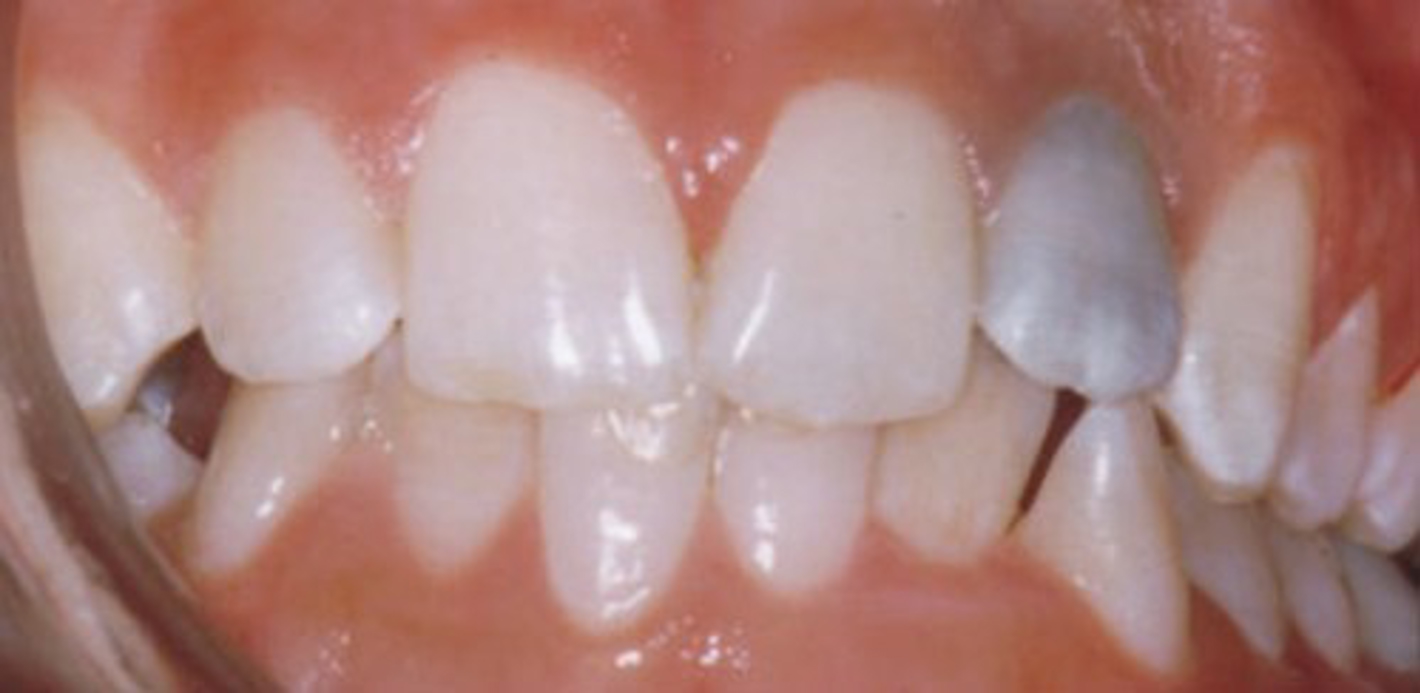 På billedet ses en tand med misfarvning.