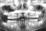 Billedet viser et panorama røntgenbillede af hele tandsættet.