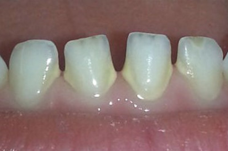 Billedet viser tandsten på tænderne i undermunden.