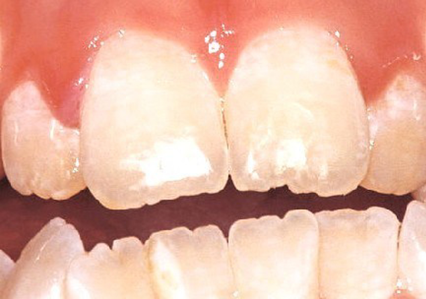 Billedet viser et par hvide fortænder efter behandling af misfarvning.