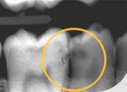 Røntgenbillede af et stort hul på siden af en kindtand.