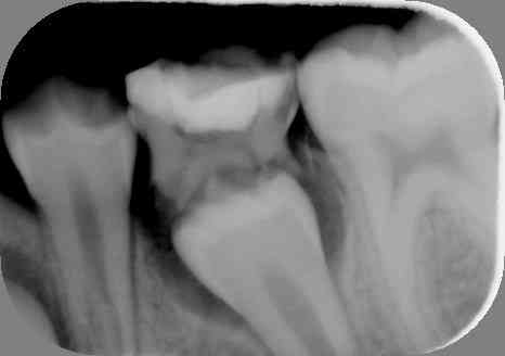 Røntgenbillede der viser den blivende tand under mælketanden.