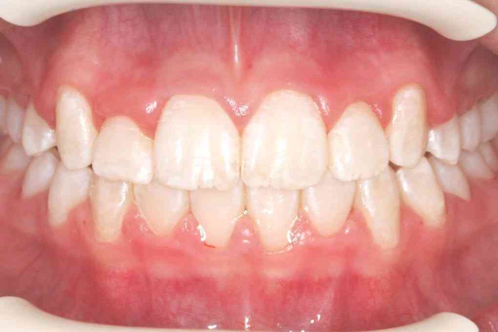 Billedet viser et lige tandsæt efter en bøjlebehandling.