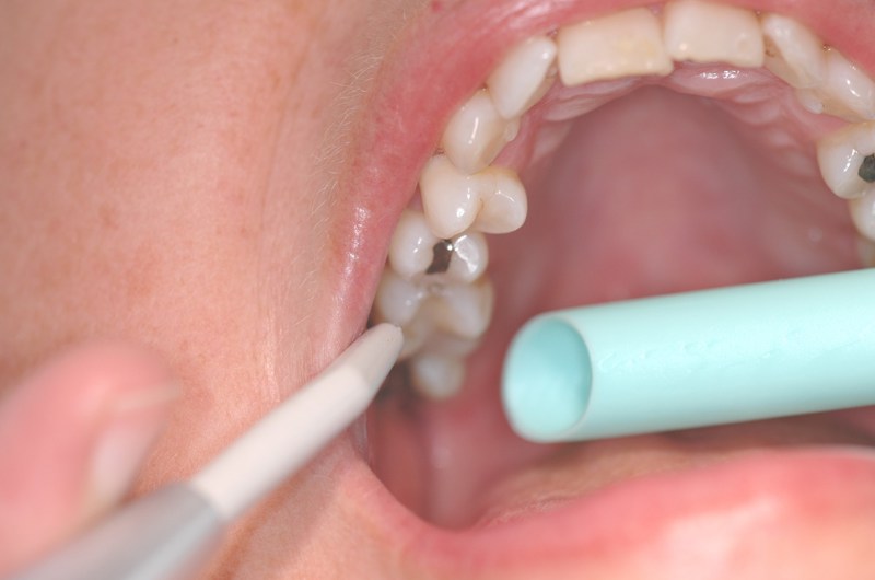 Billedet viser en tand der bliver lakeret.