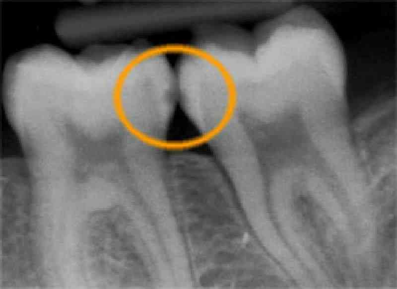 Røntgenbillede med ring om et hul mellem to kindtænder.