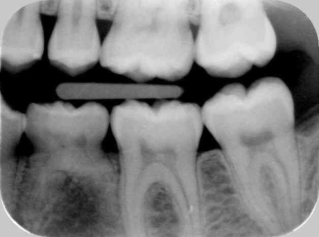 Røntgenbillede der viser manglende tandanlæg.