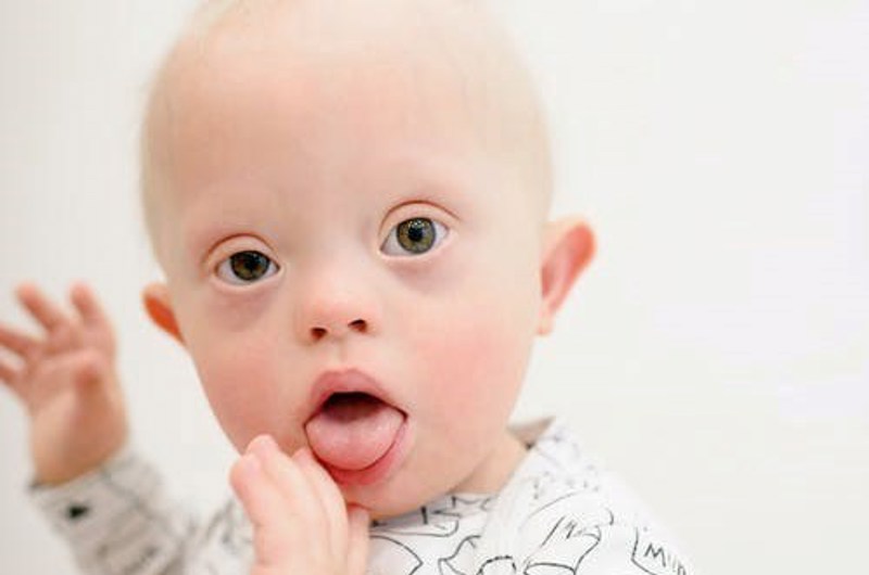 Billedet viser en lille dreng med Down syndrom.