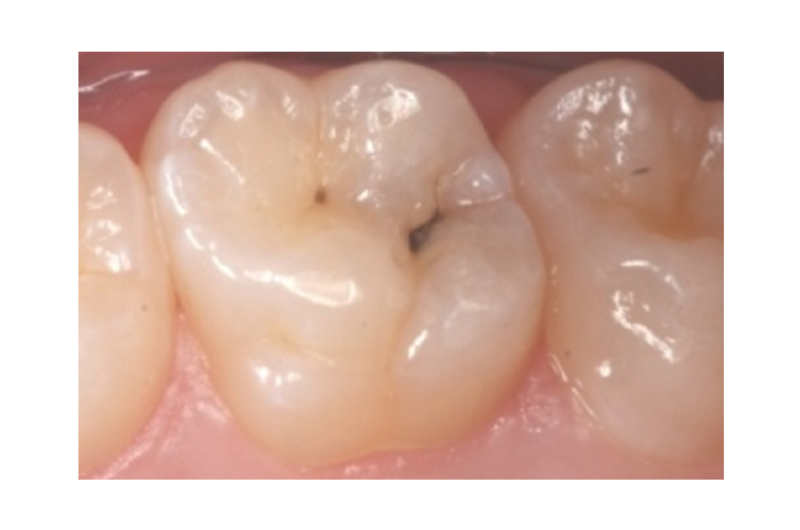 Billedet viser en kindtand med caries
