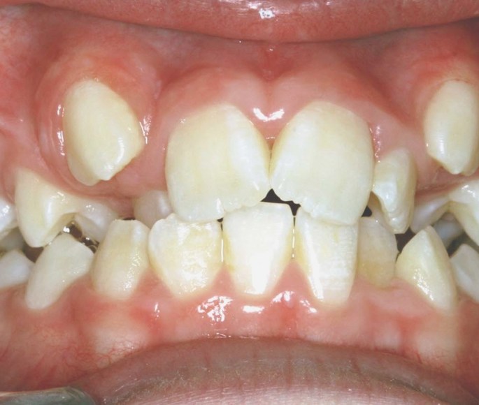 Billedet viser et skævt sæt tænder.