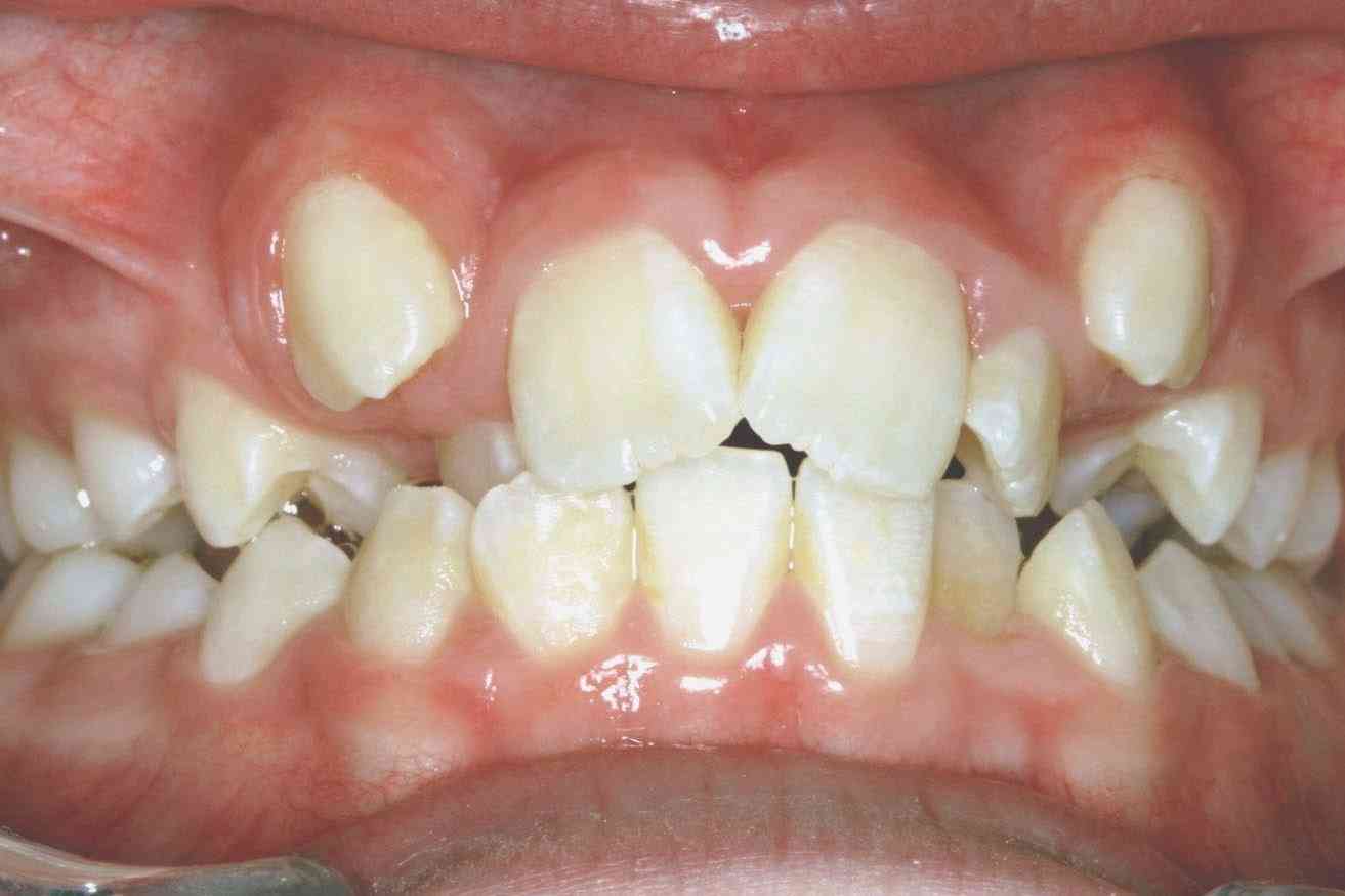 Billedet viser et skævt sæt tænder.