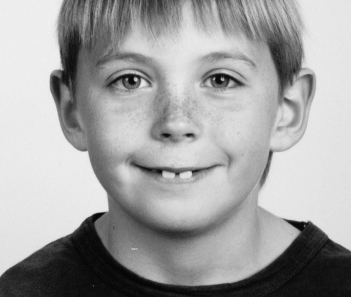 Billedet viser Alexander som 9 årig med mindre mellemrum mellem tænderne.