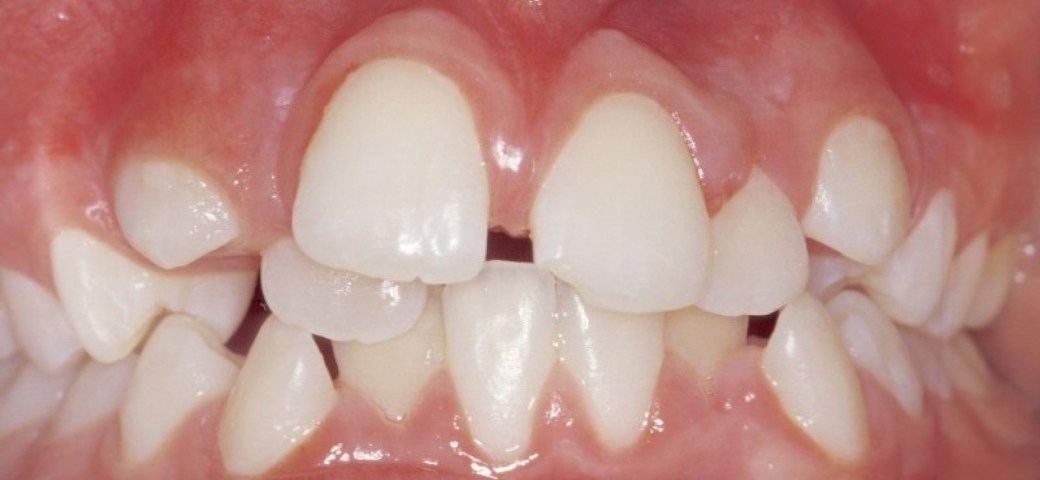 Billedet viser et skævt tandsæt.
