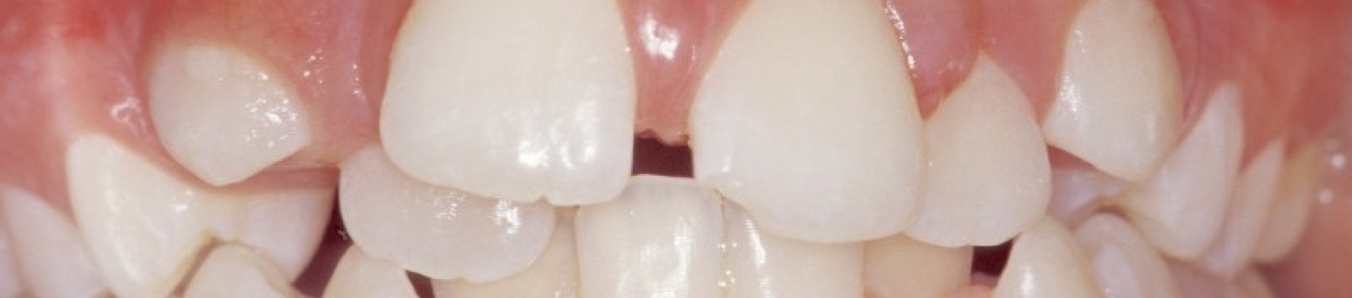 Billedet viser et skævt tandsæt.