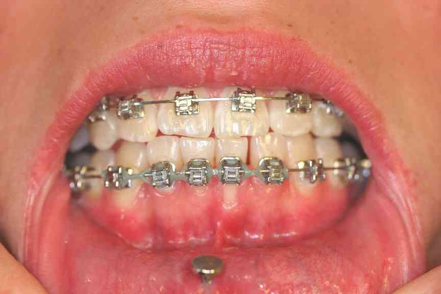 Billedet viser en piercing skade på tandkødet ved fortænderne.