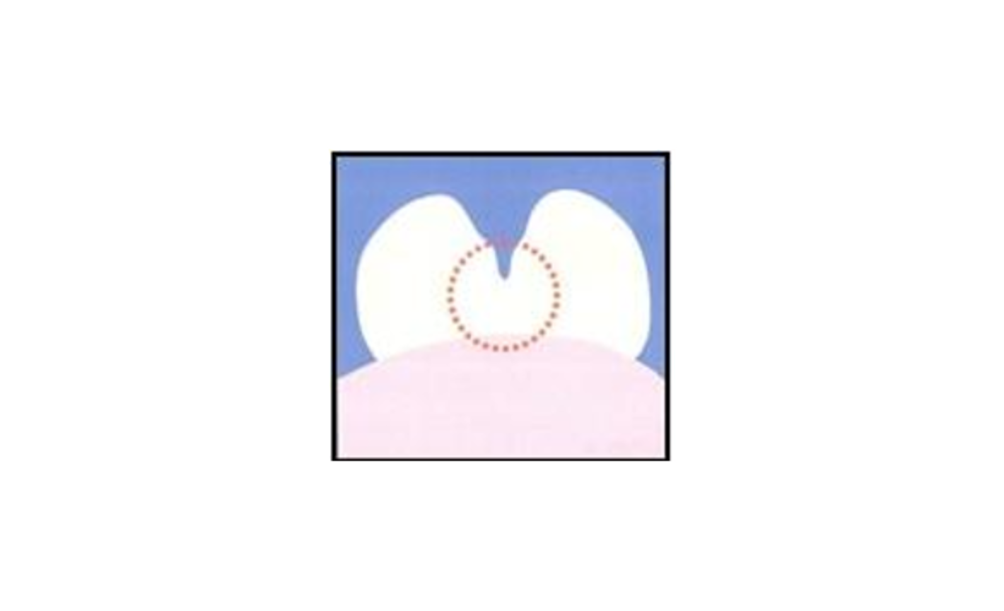 Tegningen viser en dyb fure i en kindtand.