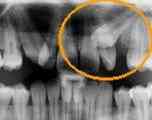 Røntgenbillede af en tand der sidder meget skævt og har brug for operaton.
