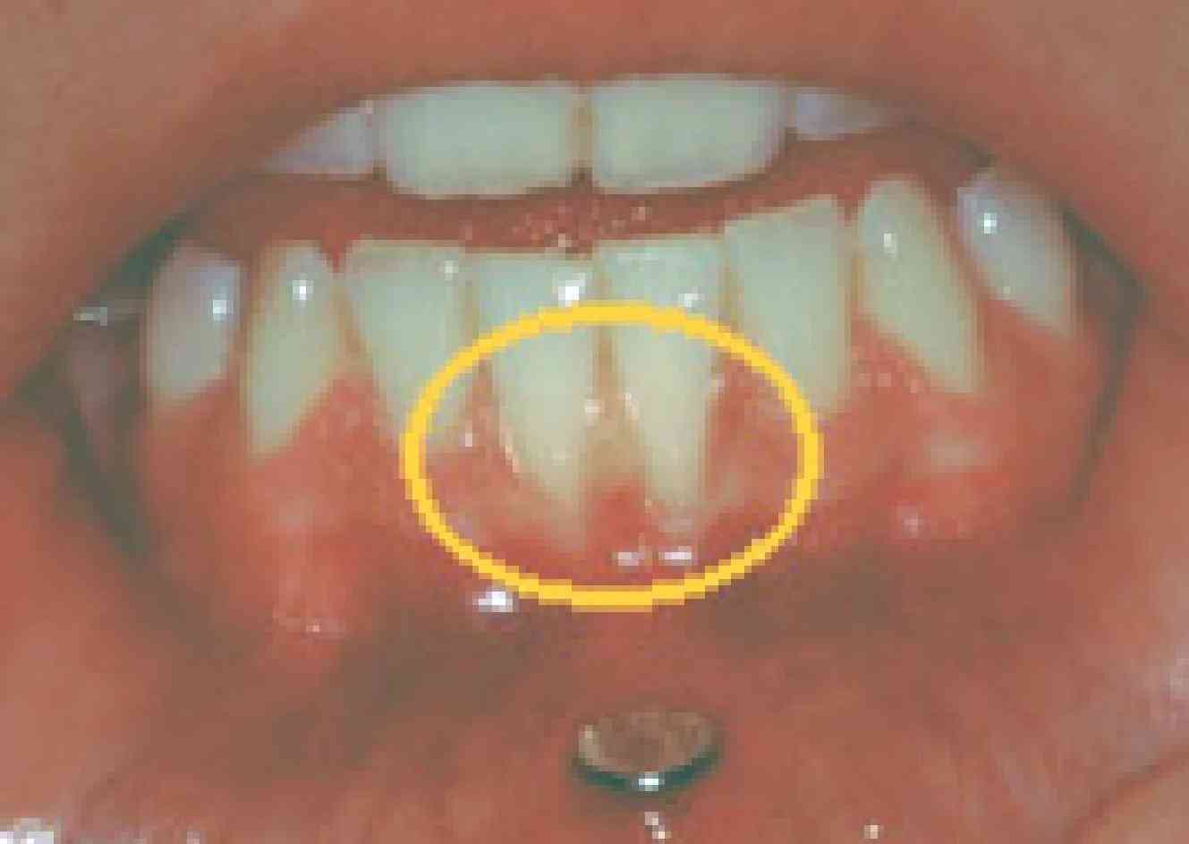 Billedet viser en skade på tandkødet efter en piercing i underlæben.