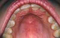 Billedet viser en skade i ganen efter en tungepiercing.